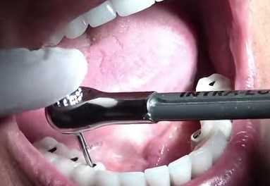 dental implants