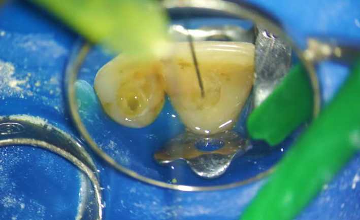 Endodontic Retreatment