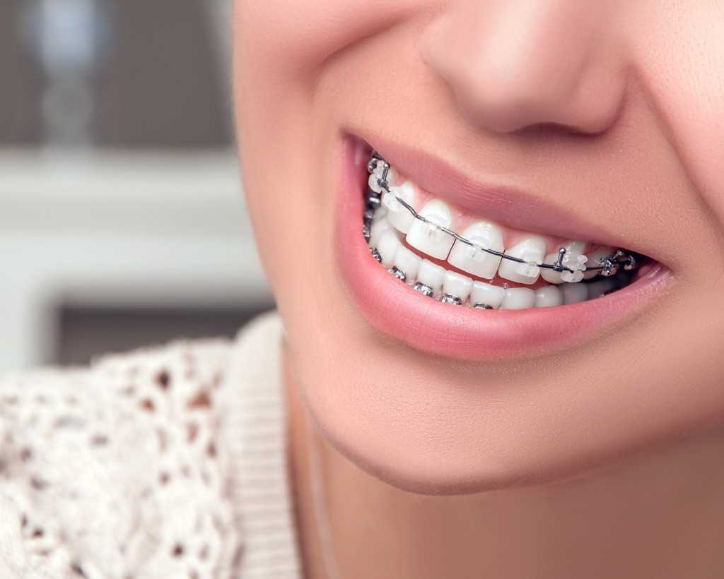 Dental Braces