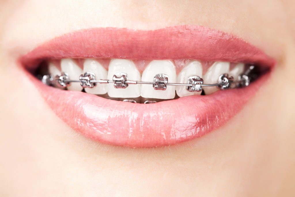 Close up shot of a lady with metal teeth braces