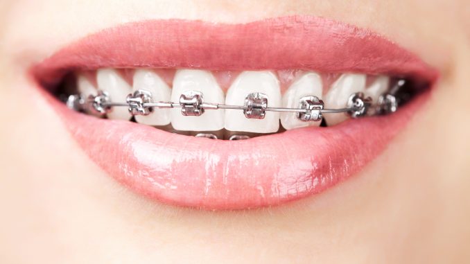 Close up shot of a lady with metal teeth braces