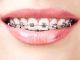 Close up shot of a lady with metal teeth braces