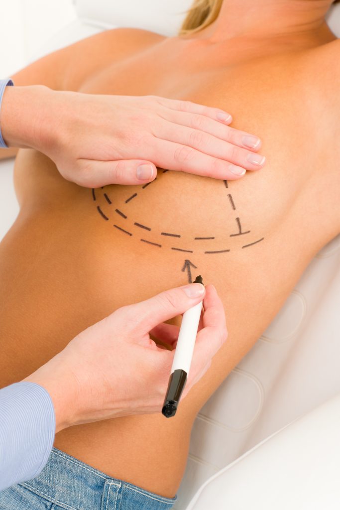 Plastic surgery doctor draw line on patient breast augmentation implant