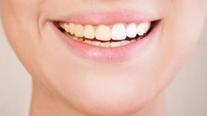 close up shot of woman's teeth