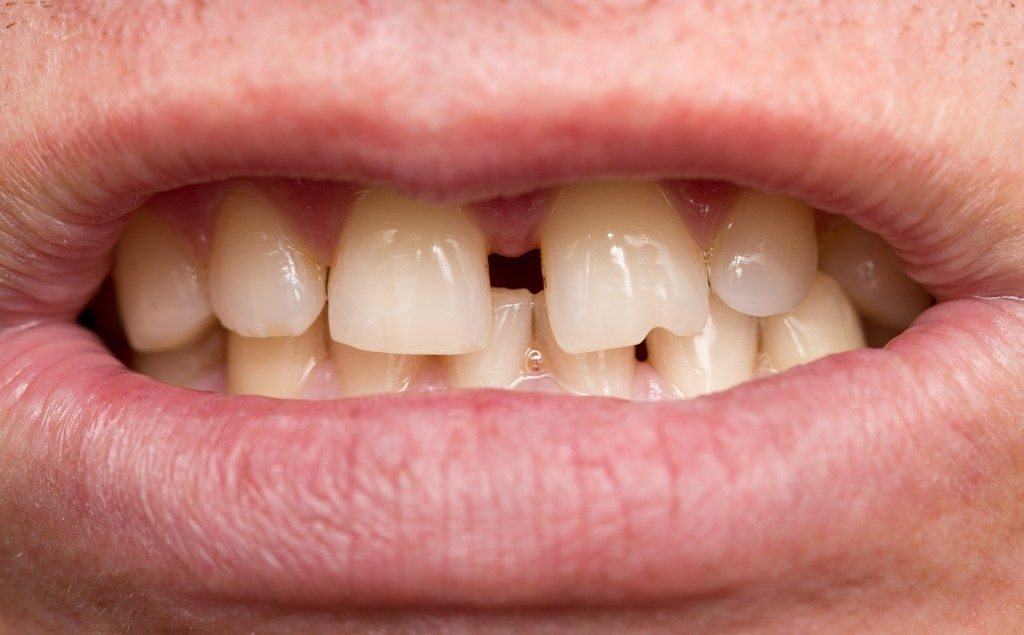 Close up of crooked teeth