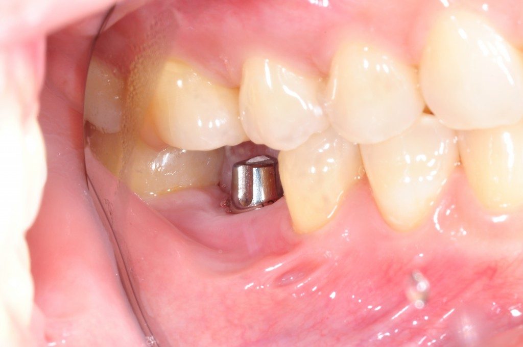 dental implant