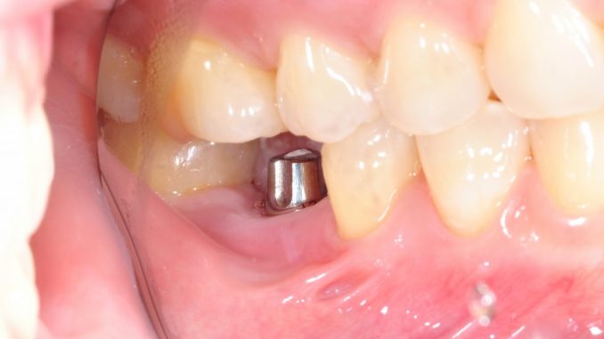 dental implant