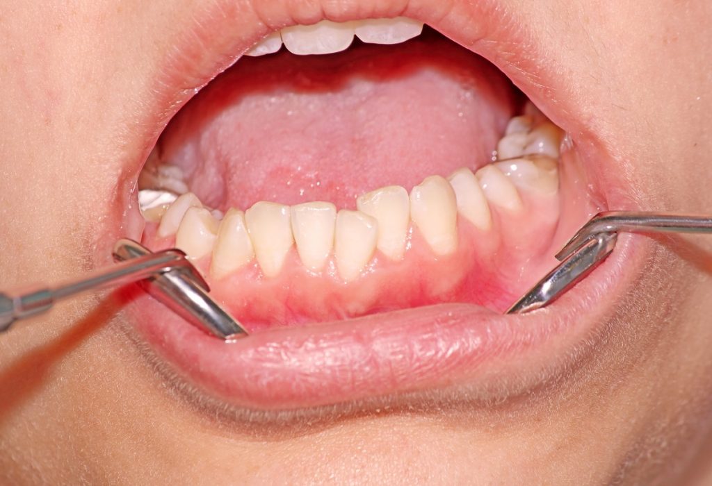 crowded teeth