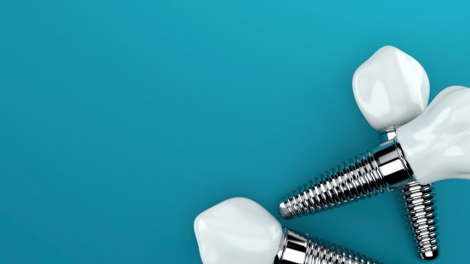 dental implant